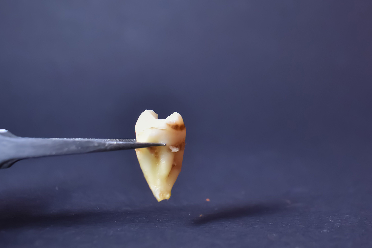 Amity Dentistry - Veneers