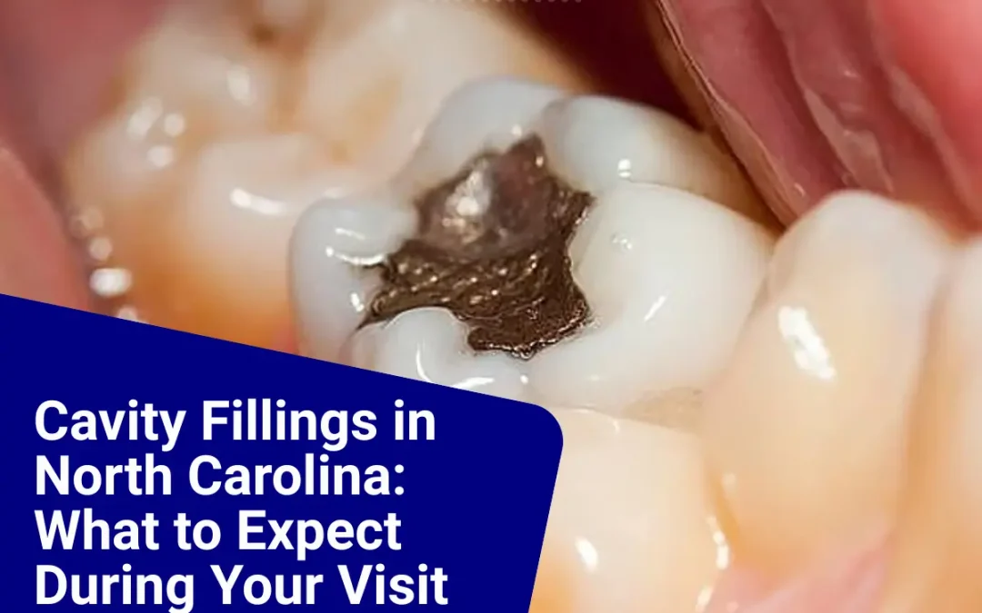 Cavity Fillings in North Carolina: What to Expect During Your Visit