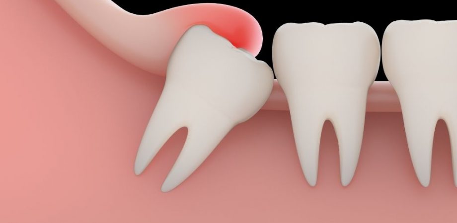 Wisdom Teeth