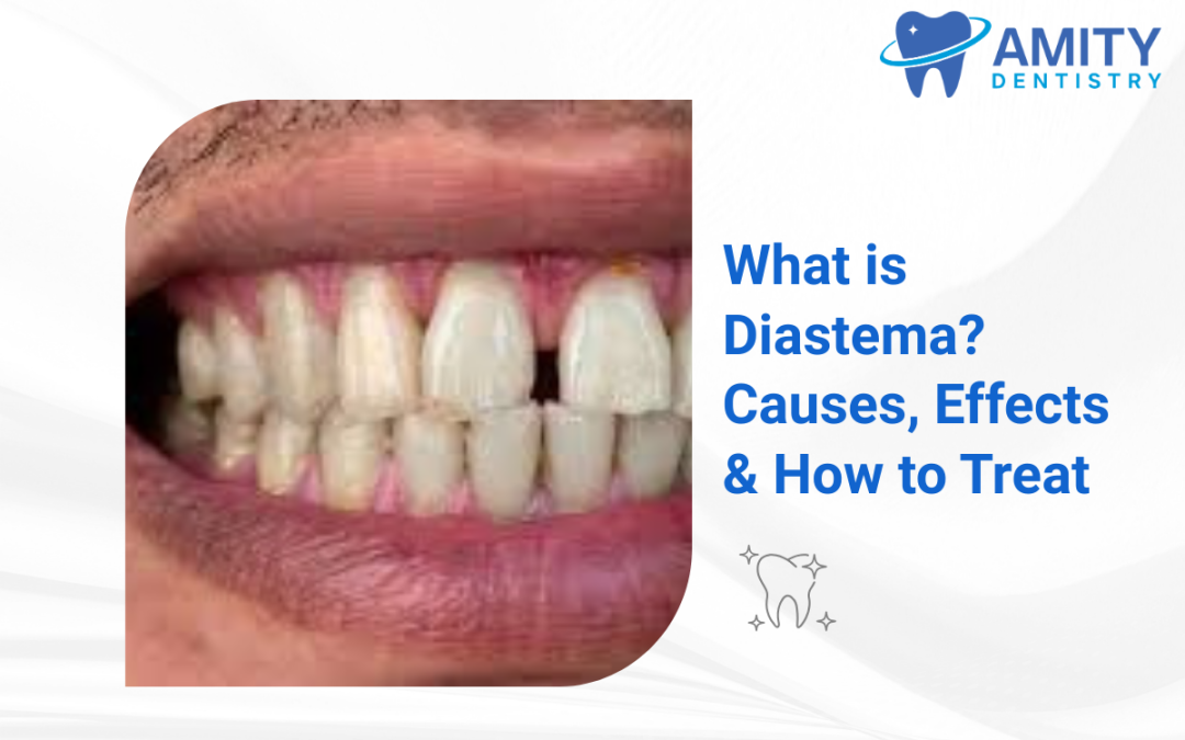 Diastema