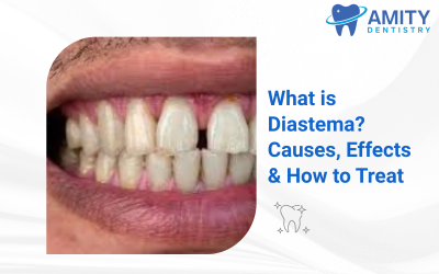 What Is a Diastema? Causes, Effects, and Treatment Options