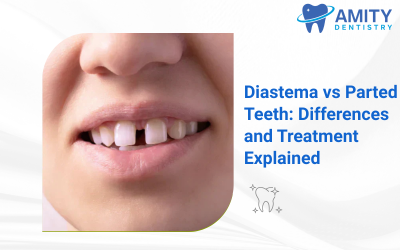 Diastema vs Parted Teeth: Differences and Treatment Explained