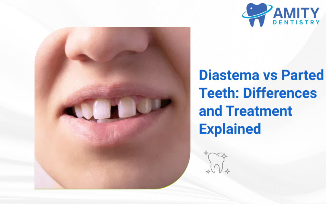 Diastema vs Parted Teeth Guide
